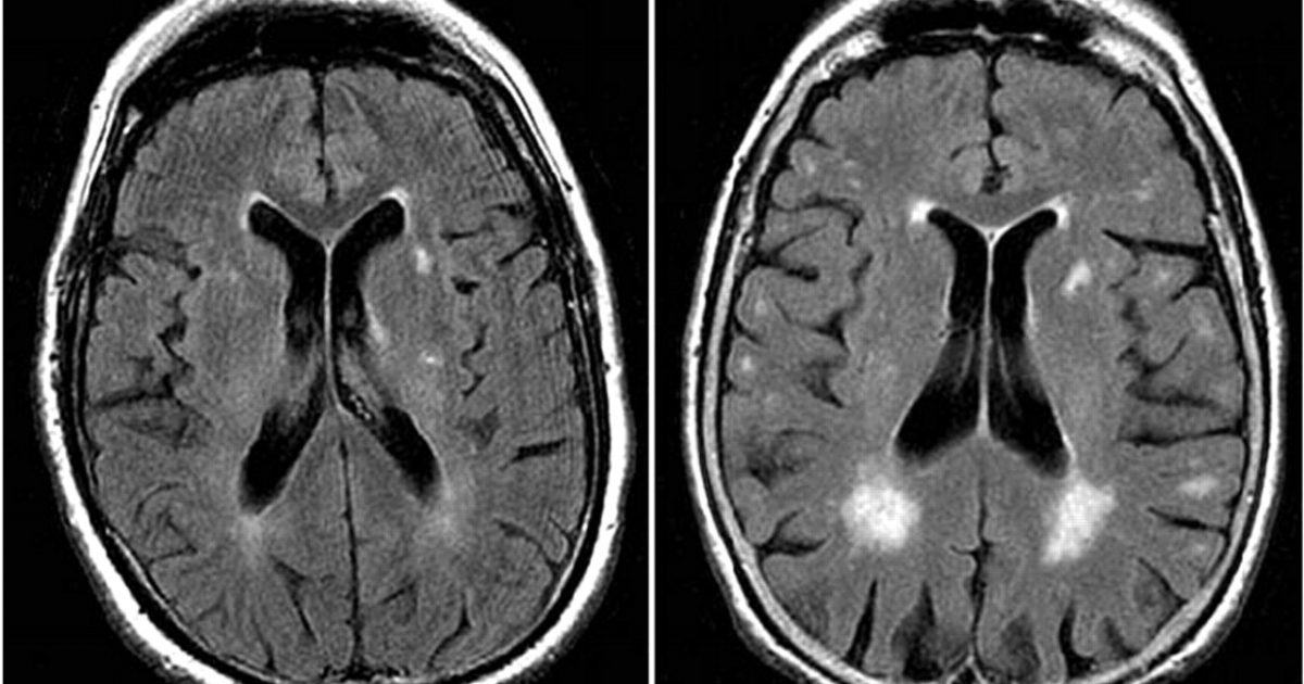 MRI Can Reveal Risk for Alzheimer's Disease