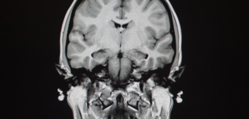 Alzheimer’s May Progress Through Spread of a Brain Tau Protein Alzheimer’s May Progress Through Spread of a Brain Tau Protein