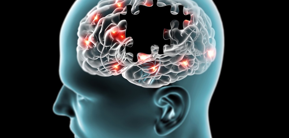 Potential Alzheimer’s Treatment, Now in Phase 3 Testing, Gets Boost from FDA Potential Alzheimer’s Treatment, Now in Phase 3 Testing, Gets Boost from FDA