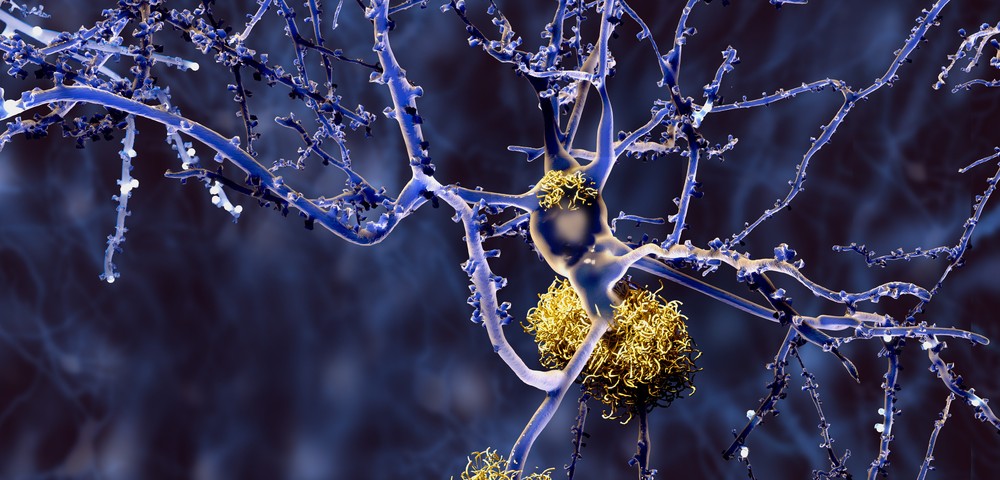 Cerebrospinal Fluid Biomarker Could Help Identify Early Alzheimer’s Disease Cerebrospinal Fluid Biomarker Could Help Identify Early Alzheimer’s Disease