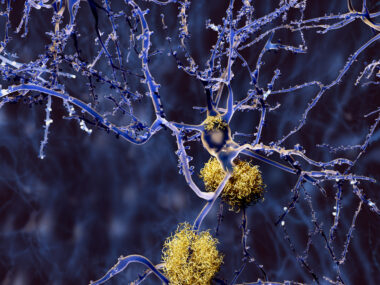 amyloid accumulation