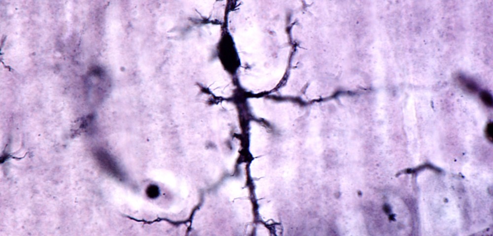 Alzheimer’s Disease Appears to Be Driven by Brain Inflammation Alzheimer’s Disease Appears to Be Driven by Brain Inflammation