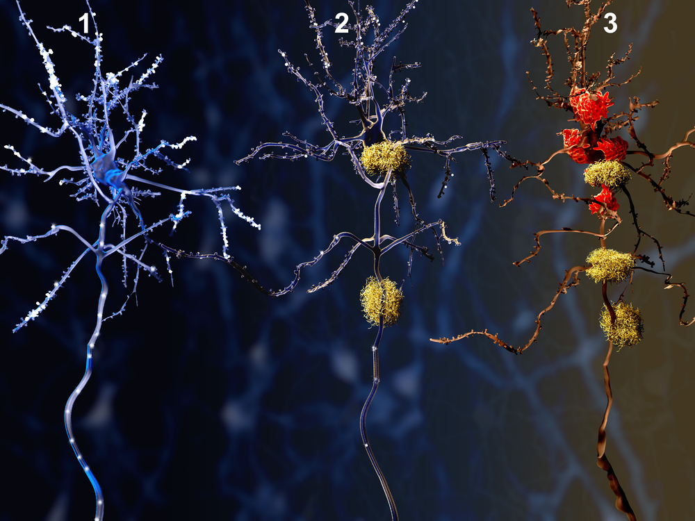 Alzheimer's drug reduces amyloid plaques