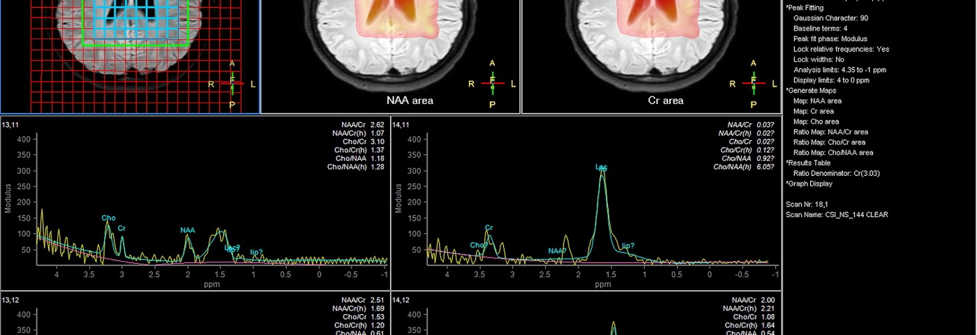 In Alzheimer’s Patients, Deep Brain Stimulation Appears to Be Effective and Safe Treatment In Alzheimer’s Patients, Deep Brain Stimulation Appears to Be Effective and Safe Treatment