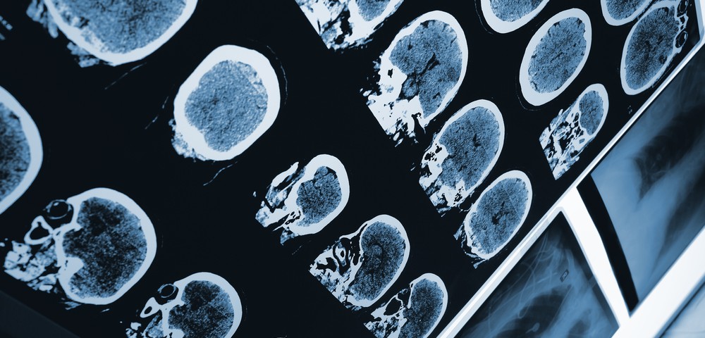 PET Imaging Seen as Valuable Tool for Alzheimer’s Staging, Diagnostics PET Imaging Seen as Valuable Tool for Alzheimer’s Staging, Diagnostics