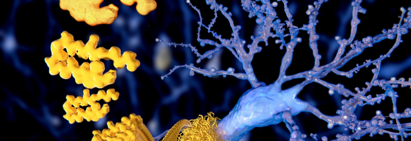 Alzheimer’s-linked Buildup of Amyloid Beta More Common Than Thought, Study Finds Alzheimer’s-linked Buildup of Amyloid Beta More Common Than Thought, Study Finds