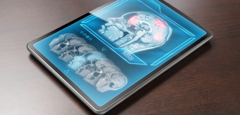 Short-Term Memory Aided by Single Dose of Methylene Blue in Early Study Short-Term Memory Aided by Single Dose of Methylene Blue in Early Study