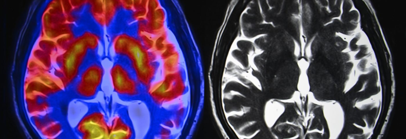 Biomarkers for Alzheimer’s Are Focus of Large Study Getting Underway in UK Biomarkers for Alzheimer’s Are Focus of Large Study Getting Underway in UK
