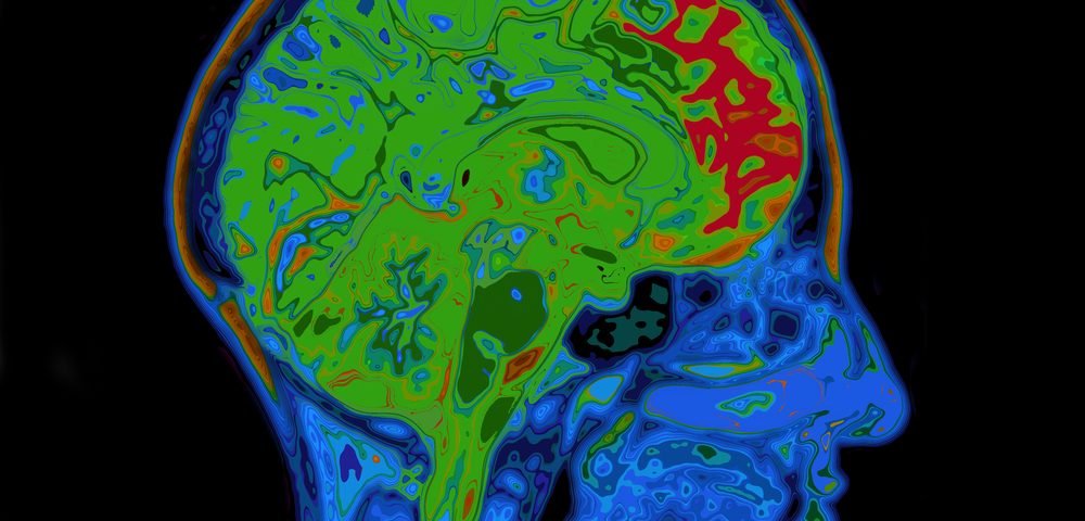 Moderate but Not Low-intensity Exercise Might Help Protect Brain from Alzheimer’s Moderate but Not Low-intensity Exercise Might Help Protect Brain from Alzheimer’s