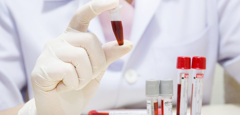 Blood Test Seen to Identify Alzheimer’s with Accuracy, Including Early-stage Disease Blood Test Seen to Identify Alzheimer’s with Accuracy, Including Early-stage Disease