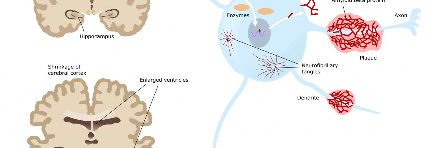 ProMIS’s PMN310 Antibody Therapy Binds Only to Toxic Forms of Amyloid Beta, Study Reports ProMIS’s PMN310 Antibody Therapy Binds Only to Toxic Forms of Amyloid Beta, Study Reports