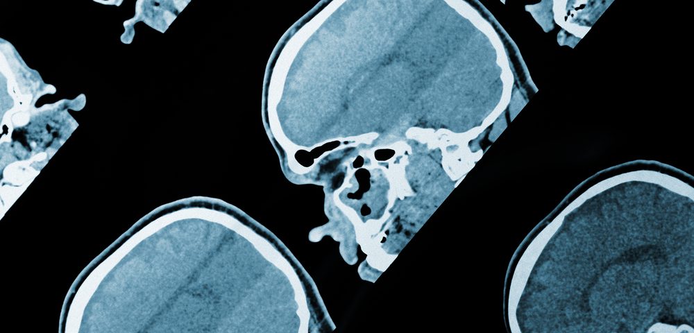 Harmful Tau Protein Shows Up in One Brain Area, Then Spreads, Study Reports