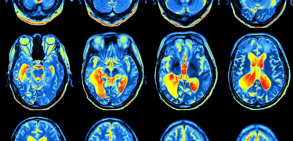 FDG PET Scan More Accurately Assesses Severity of Cognitive Decline in Alzheimer’s, Study Finds FDG PET Scan More Accurately Assesses Severity of Cognitive Decline in Alzheimer’s, Study Finds