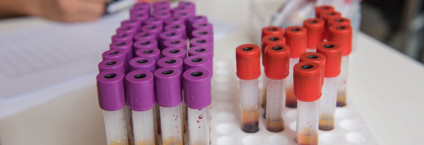 New Blood Test May Help Detect Beta-Amyloid Plaques in People at Risk of Alzheimer’s, Study Shows New Blood Test May Help Detect Beta-Amyloid Plaques in People at Risk of Alzheimer’s, Study Shows