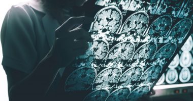 Aduhelm for early Alzheimer's | Alzheimer's News Today | view of brain scans