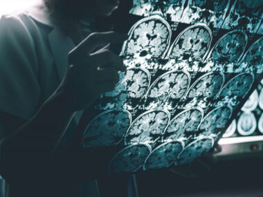 Aduhelm for early Alzheimer's | Alzheimer's News Today | view of brain scans