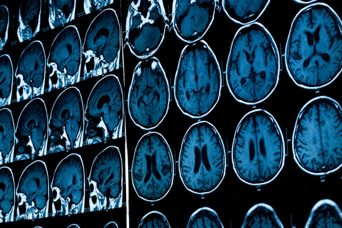 New MRI Method May Help Detect Early Stage Alzheimer's Alzheimer's News ...